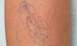 cómo tratar las varices en las mujeres